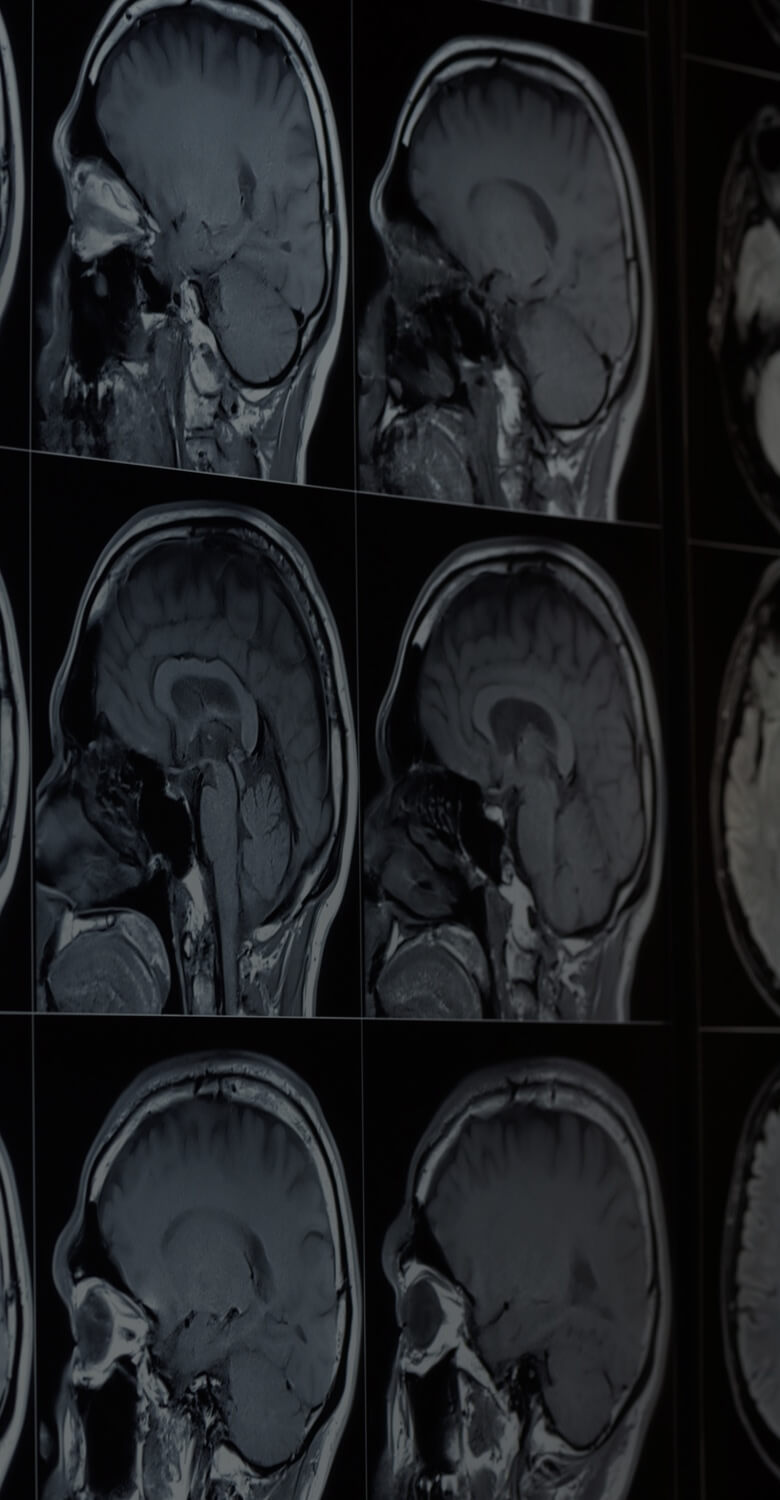 Microplastics in brain scans highlight potential health impacts of pollution.